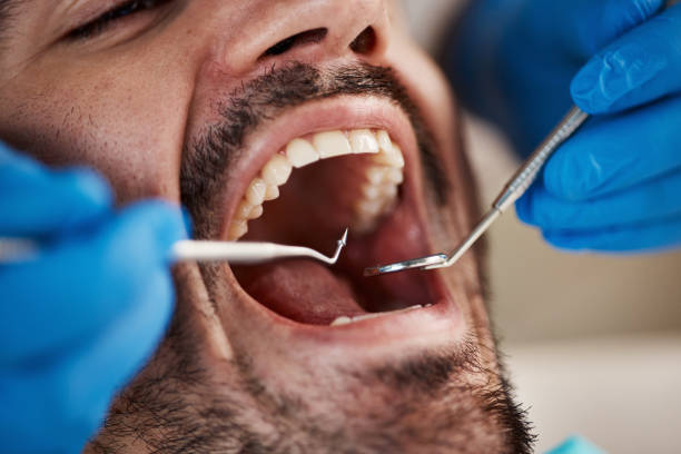 Best Emergency Wisdom Teeth Removal in Mount Washington, KY